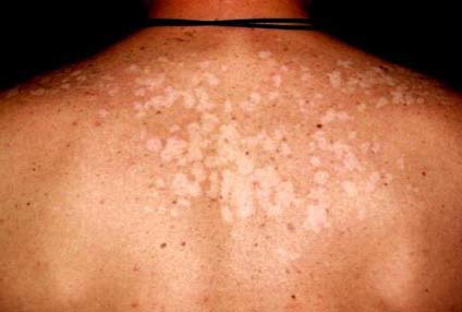 Tratamiento para las manchas blancas en la piel de la espalda