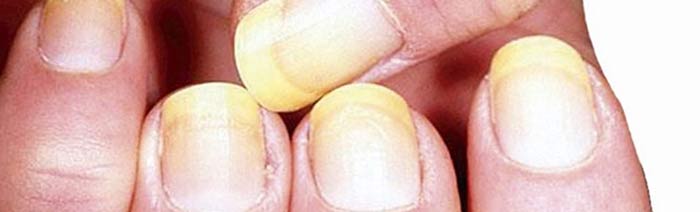 Tratamiento para uñas amarillas