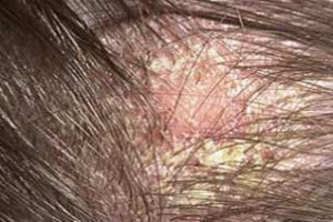 Tratamiento para dermatitis seborreica