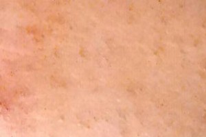 Tratamiento para los granos