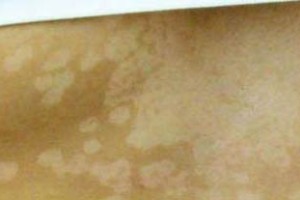 Tratamiento para las manchas blancas en la piel