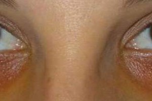 Tratamiento para ojeras oscuras