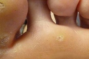 Tratamiento para ojos de pescado en los pies