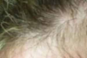 Tratamiento para que nazca cabello