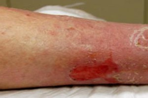 Tratamiento para úlceras varicosas