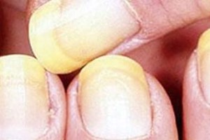 Tratamiento para uñas amarillas