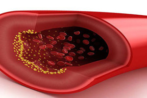 Tratamiento para bajar el colesterol