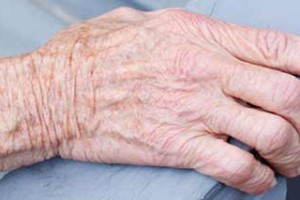 Tratamiento para el reumatismo