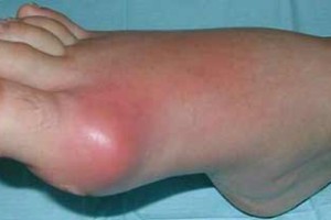 Tratamiento para la gota