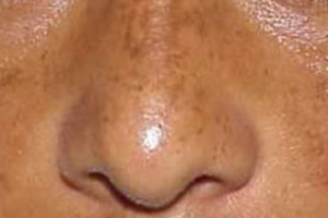 Tratamiento para melasma