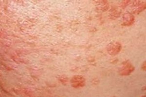 Tratamiento para verrugas planas