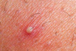 Tratamiento para la foliculitis