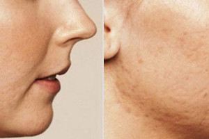 Tratamiento para marcas de acné