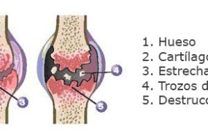 Tratamiento para osteoartritis