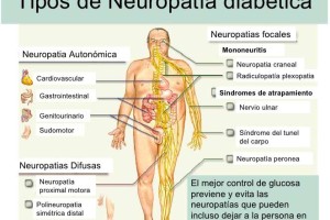 Tratamiento para neuropatía diabética