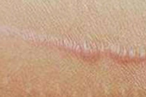 Tratamiento para queloides