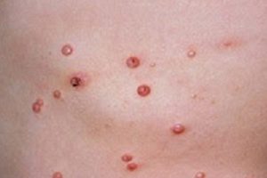 Tratamiento para molusco contagioso