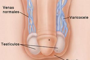 Tratamiento para varicocele