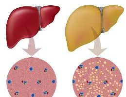 Tratamiento para el hígado graso