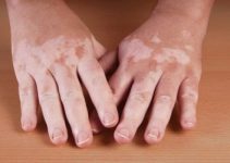 Tratamiento para el vitiligo