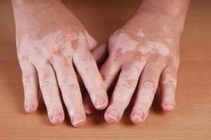 Tratamiento para el vitiligo