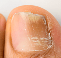 Tratamiento para uñas con hongos