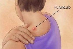 Tratamiento para forúnculos
