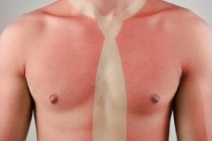 Tratamiento para quemaduras de sol